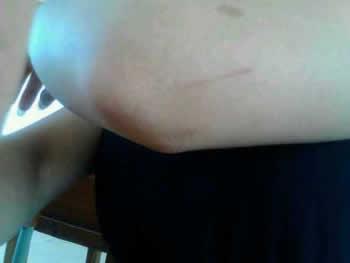 胳膊划伤的照片